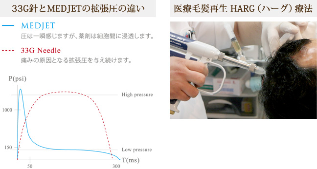 33G針とMEDJETの拡張圧の違い、医療毛髪再生HARG（ハーグ）療法