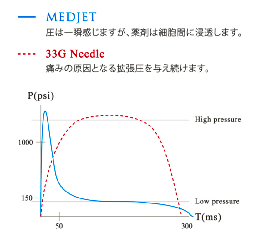 33G針とMEDJETの拡張圧の違い
